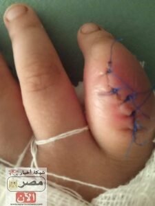 صورة لورم يد الطفل محمد إيهاب