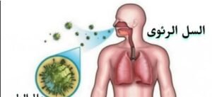 تزامنا مع الأحتفال باليوم العالمى لمكافحة السل 24 مارس ،الأمم المتحدة تشيد بتجربة مصر فمكافحة السل