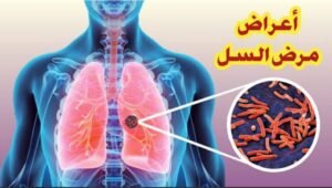 تزامنا مع الأحتفال باليوم العالمى لمكافحة السل 24 مارس