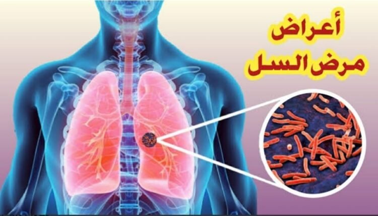 تزامنا مع الأحتفال باليوم العالمى لمكافحة السل 24 مارس